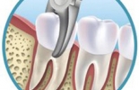 Extração dentária simples