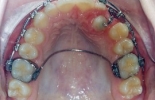 Exposição de dentes inclusos para tracionamento ortodôntico