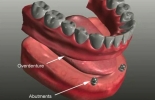 Overdenture