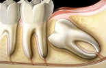 Extração de dentes siso