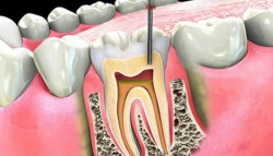 Endodontia (canal)