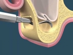 Cirurgia de Levantamento de Seio Maxilar